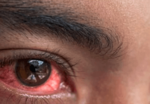 Caabuq indhaha saameeya oo ka dillaacay Mombasa